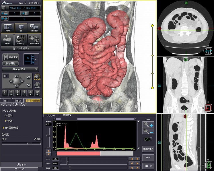 CTによる大腸仮想内視鏡検査