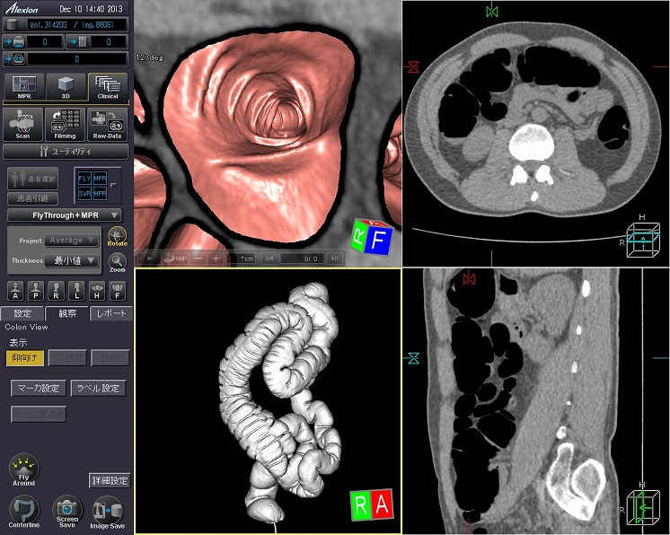 CTによる大腸仮想内視鏡検査