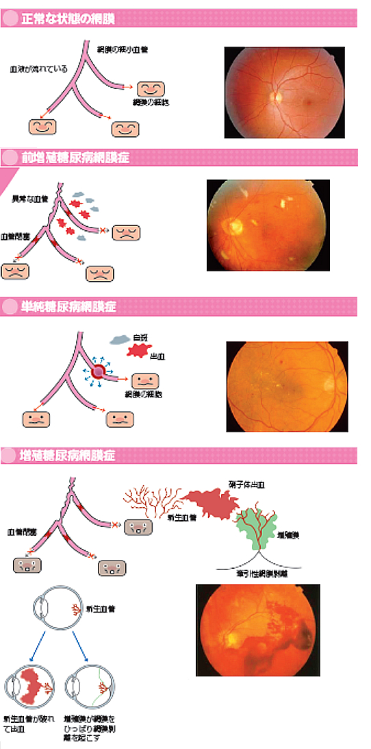 3大合併症