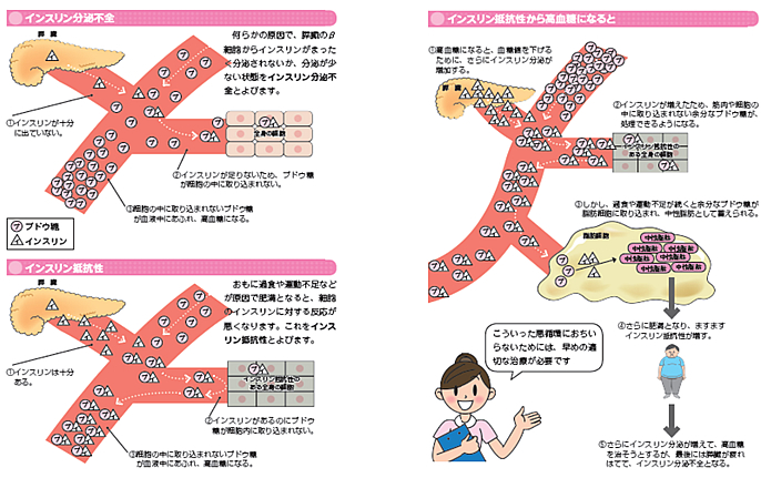 糖尿病の病態