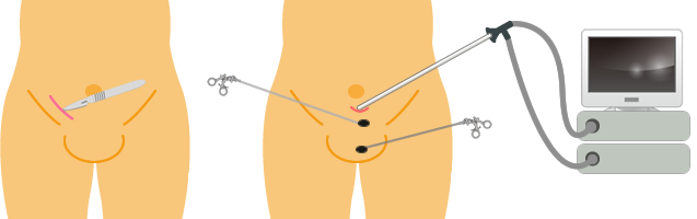 手術方法の違い